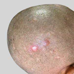 My Head Skin Hurts: Causes and Treatment Options