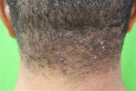 Bump on the Back of the Head: Causes, Symptoms, and Treatment