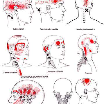 MyofascialPainSyndromeandHeadaches:AConnection
